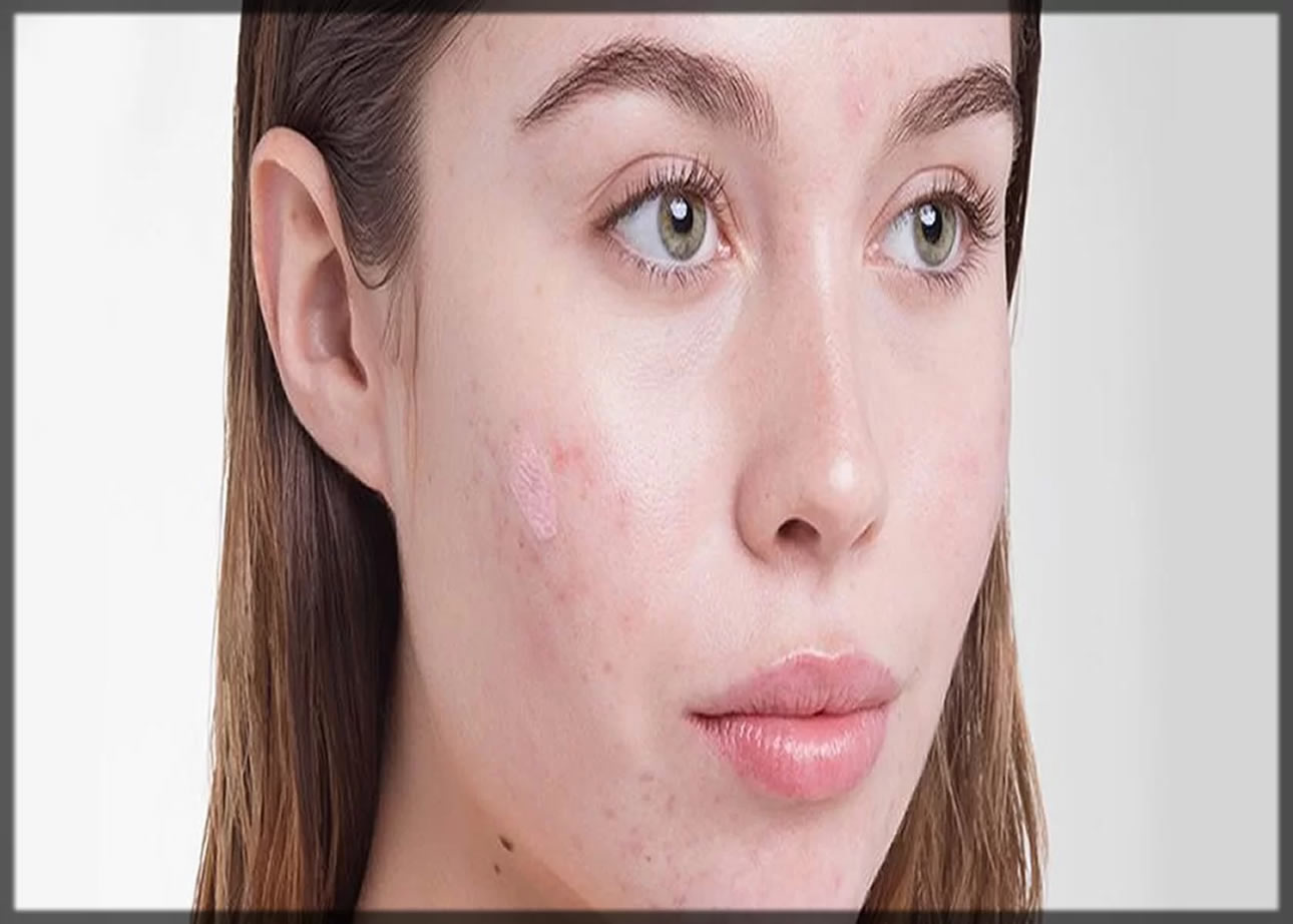 effective Acne Creams for women